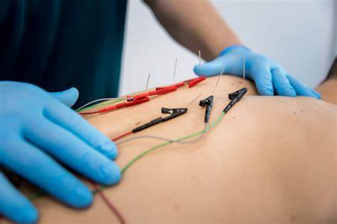 Estimulación de la médula espinal como analgesia