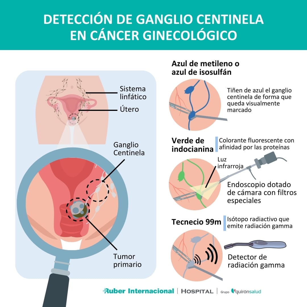 Biopsia del Ganglio Centinela: Innovación en la Evaluación del Cáncer de Mama