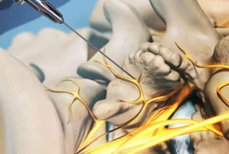 Tratamiento del dolor de trigémino