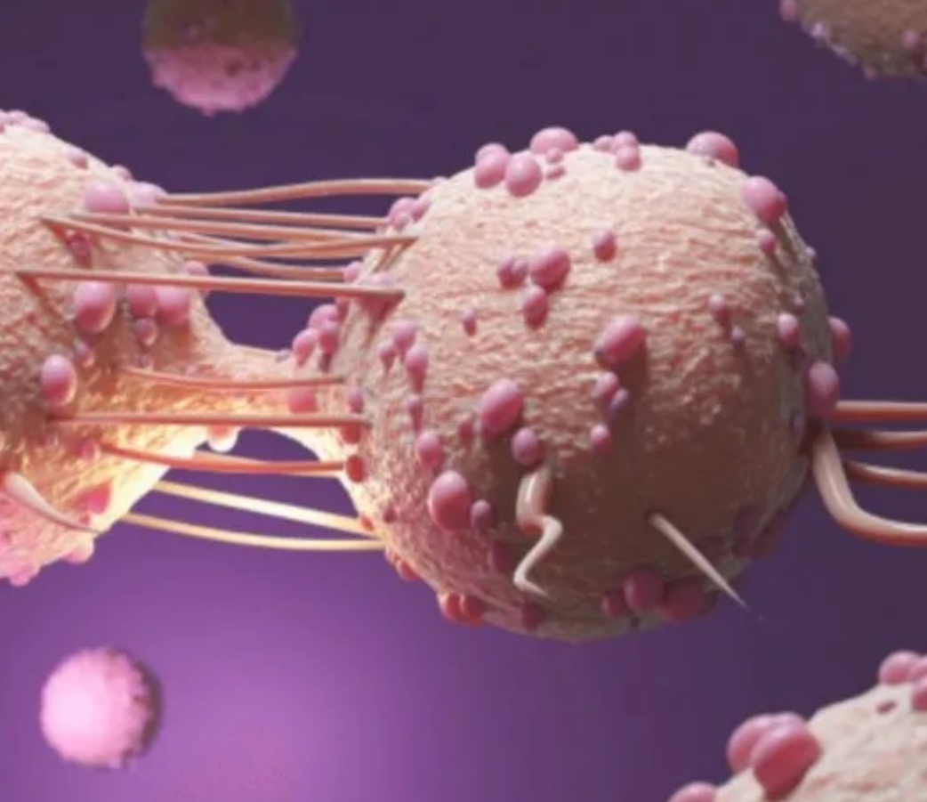 Análisis de un caso clínico de carcinoma lóbulillar infiltrante con BIRADS 4c